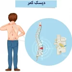 نشانه های ابتلا به دیسک کمر