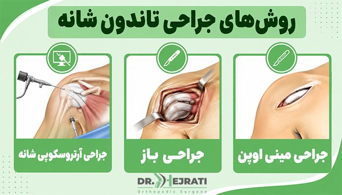 روش های جراحی تاندون شانه