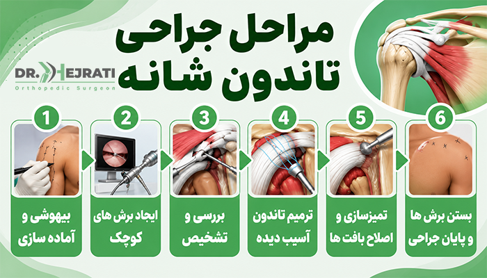 مراحل جراحی تاندون شانه در مشهد