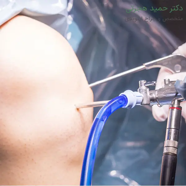تمرینات ورزشی بعد از آرتروسکوپی زانو