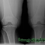 استئونکروز زانو چیست