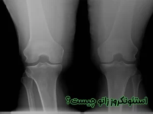 استئونکروز زانو چیست
