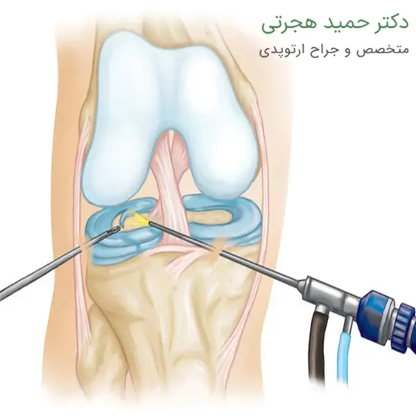 کاهش درد جراحی آرتروسکوپی زانو