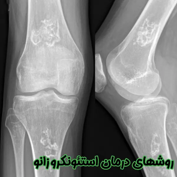 روشهای درمان استئونکروز زانو