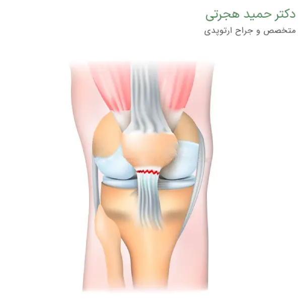 روشهای تشخیص پارگی تاندون زانو
