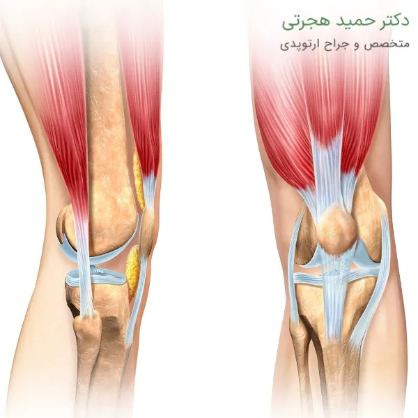 علائم پارگی تاندون زانو