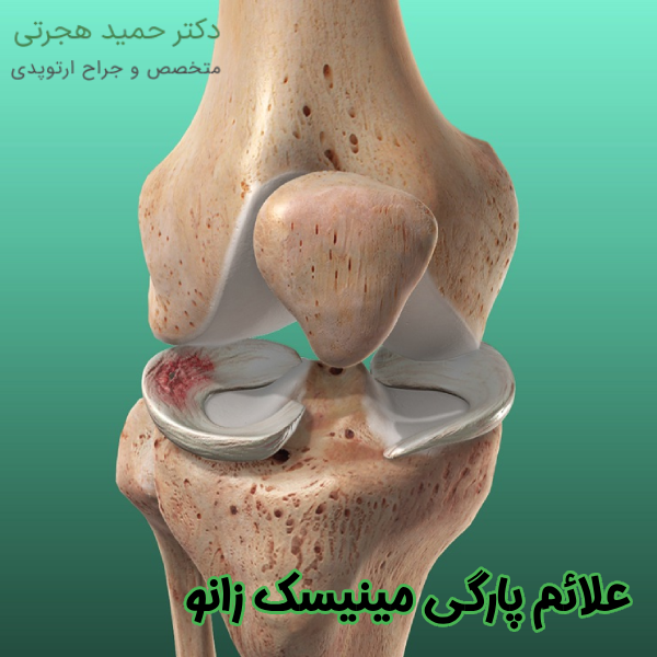 علائم پارگی مینیسک زانو