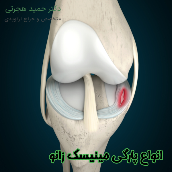انواع پارگی مینیسک زانو