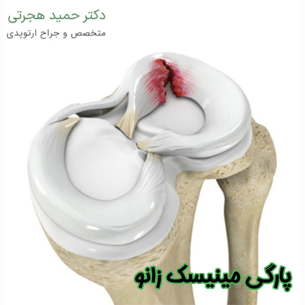 پارگی مینیسک زانو چیست
