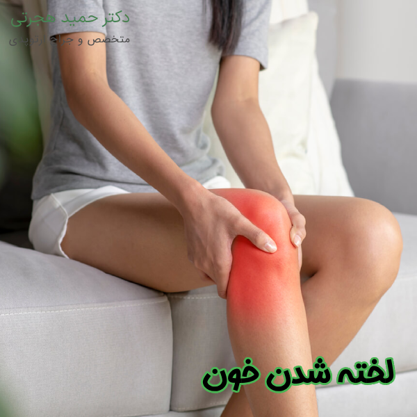 لخته شدن خون