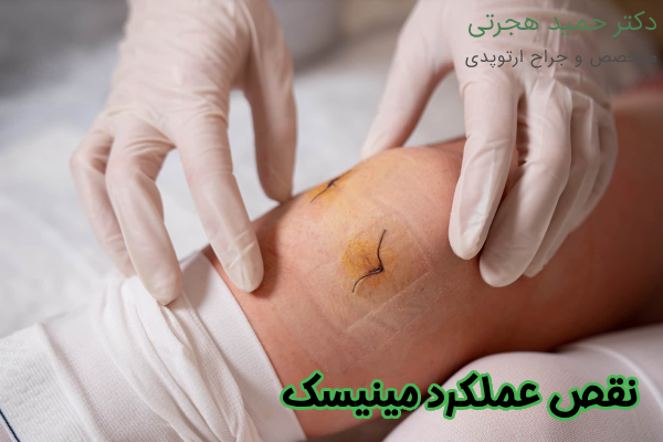 نقص عملکرد مینیسک
