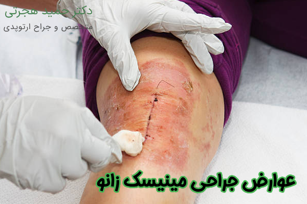 خطرات عمل مینیسک زانو