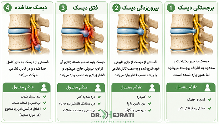 انواع دیسک کمر